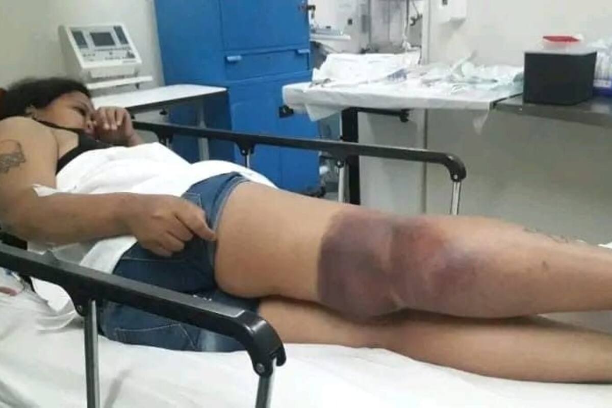 En el reverso de la rodilla le aparecieron ematomas y una coloración negruzca