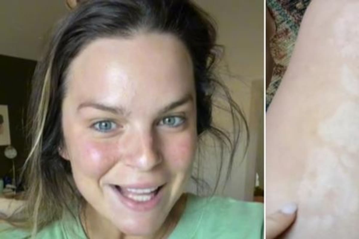 En esta imagen se aprecia a la mujer que se quedó dormida y despertó con pequeñas huellas en su pierna