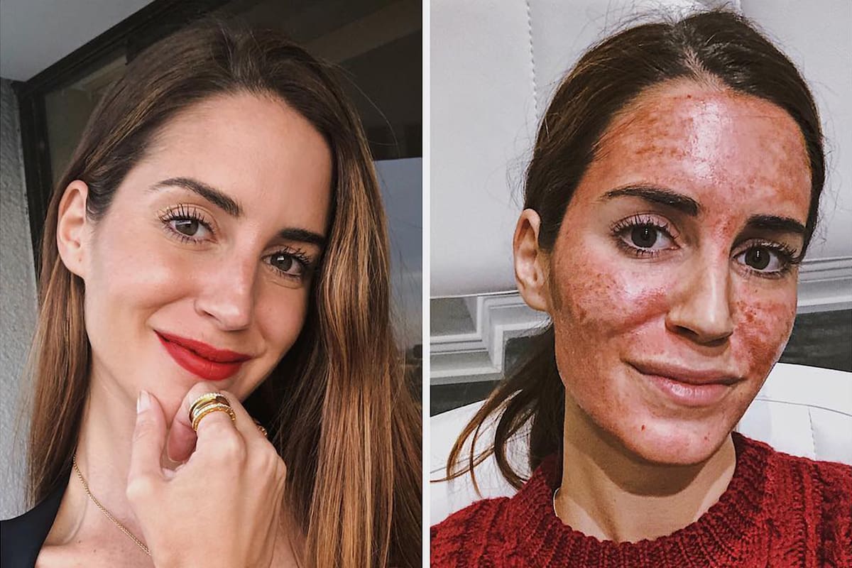 En la imagen la influencer española Gala González mostrando cómo quedo su cara luego del facial de vampiro