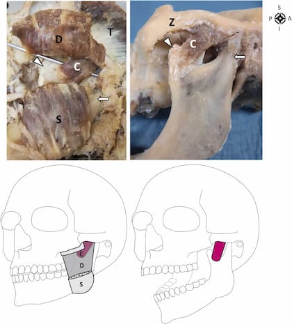 En la imagen se muestra la disección macroscópica y dibujo esquemático que representa la parte coronoide del masetero