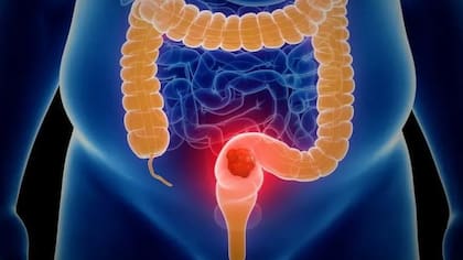 En la mayoría de los casos, el cáncer colorrectal no es hereditario
