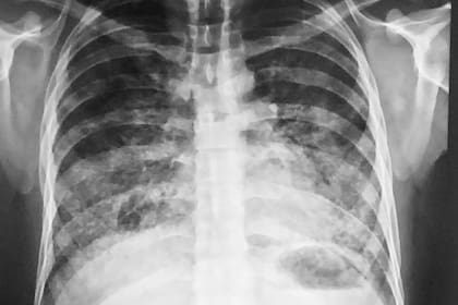 En la radiografía, el área más clara (abajo y los costados) de los pulmones (imagen más oscura) muestra cómo la lesión va desplazando el aire