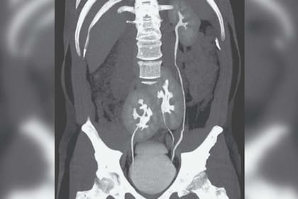 En las imágenes se ve el riñón izquierdo con apariencia normal y en el lugar del derecho hay dos órganos fusionados