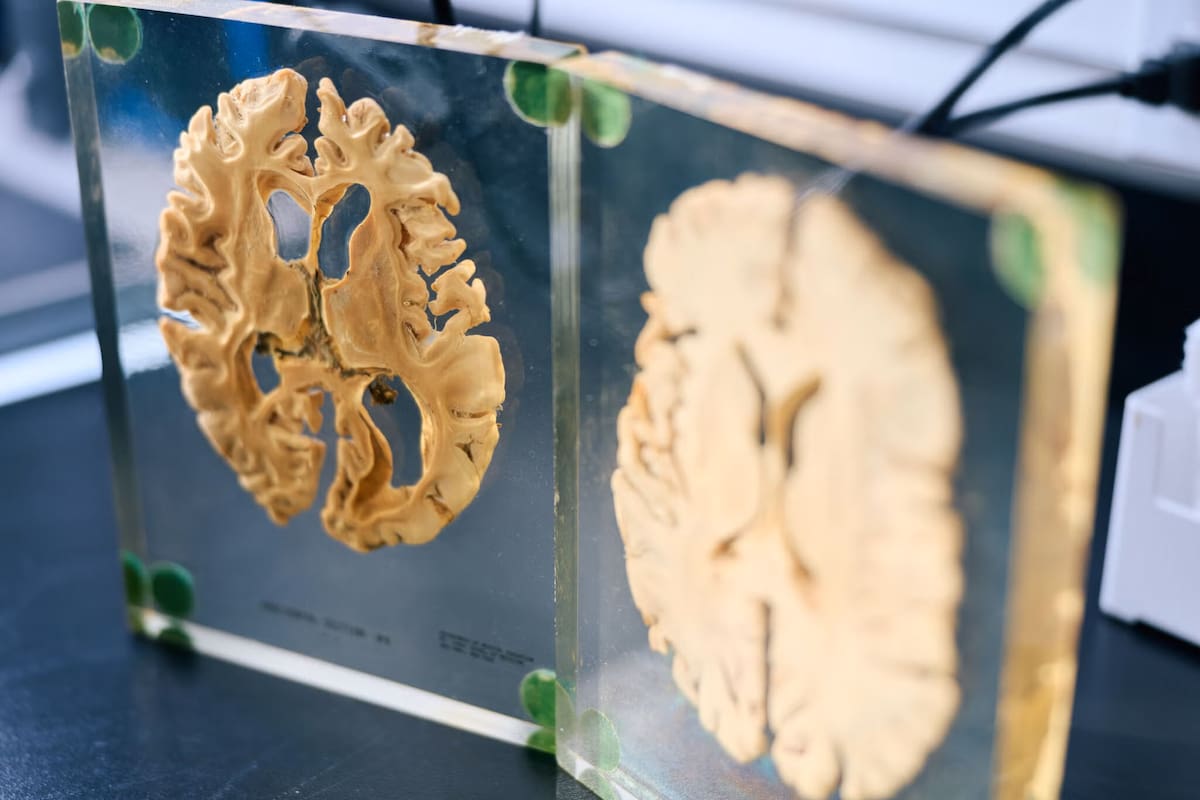 En las investigaciones del alzhéimer se analiza algo inusual: la forma de la cabeza