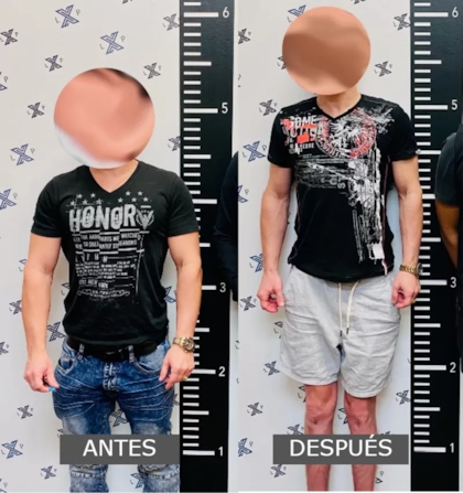 En las operaciones se pueden ganar hasta ocho centímetros