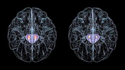 En las personas con párkinson, las células nerviosas de la región del cerebro conocida como sustancia negra, mueren. Izquierda: sustancia negra sana (naranja). Derecha: sustancia negra degenerada (amarilla).