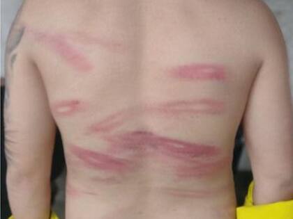 En los informes médicos se registraron hematomas, equimosis, fracturas y otras lesiones diversas