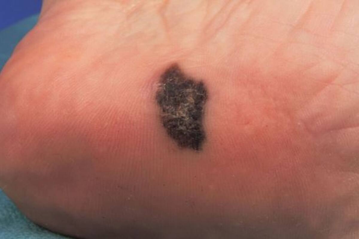 En nuestro país se registran entre 1200 y 1500 casos de melanoma por año, y unas 600 muertes