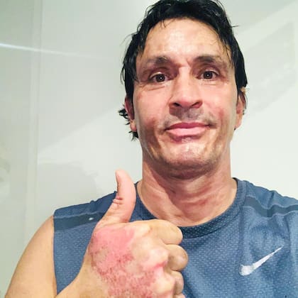 En pandemia, Sebastián Estavnez se prendió fuego cuando intentó prender un hogar a leña con alcohol (Foto: Instagram @sebastian.estevanez)