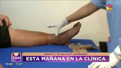 Ernesto tiene úlceras en sus piernas y debido a ello tuvo que ser internado