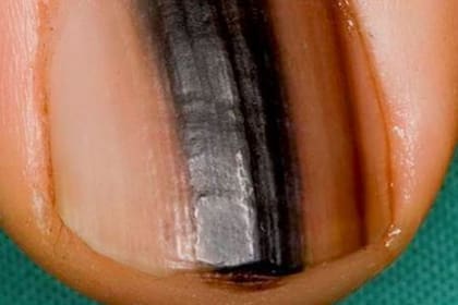 Es importante que te analices estas manchas que aparecen en las uñas