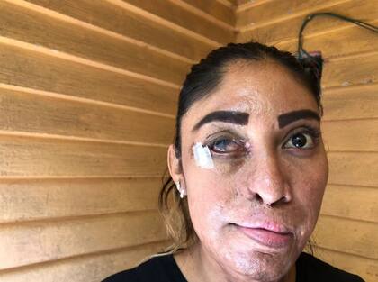Esmeralda Millán ha tenido más de 16 operaciones en los últimos años