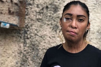 Esmeralda Millán sufrió un ataque de ácido en Puebla, México