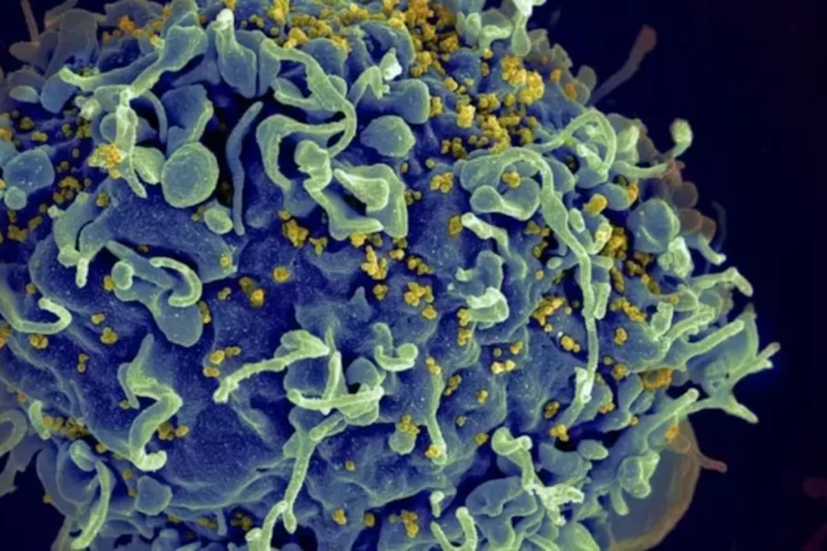 Esta electromicrografía muestra al virus VIH infectando una célula humana. La variante VB generó una mayor carga viral en pacientes que aún no reciben tratamiento.