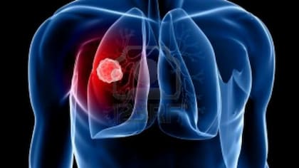 Un nódulo puede ser signo de cáncer del pulmón