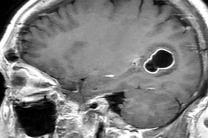 Esta imagen de resonancia magnética permite apreciar la lesión causada por la tenia del cerdo.