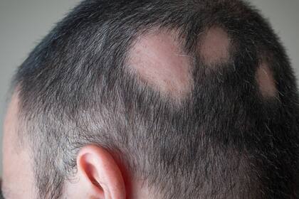 La alopecia areata es una enigmática enfermedad en la que las propias defensas del cuerpo humano atacan el cuero cabelludo