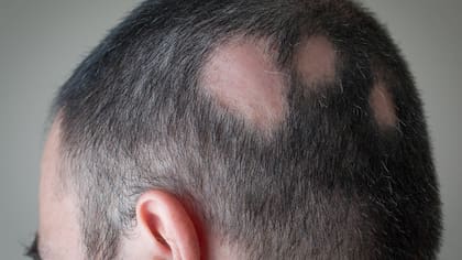El estudio podría cultivar cabello en un laboratorio