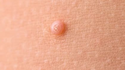 Estas son las lesiones que aparecen con el molusco contagioso