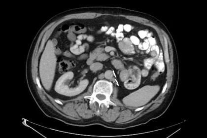 Este tipo de vacunas se encuentran entre los tratamientos novedosos más prometedores contra el cáncer