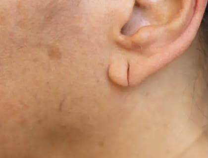 Estos son algunos de los cambios que pueden percibirse en los lóbulos.
