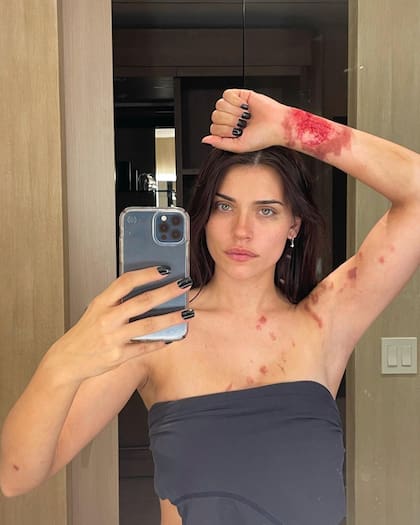 Eva De Dominici terminó con quemaduras de segundo grado B