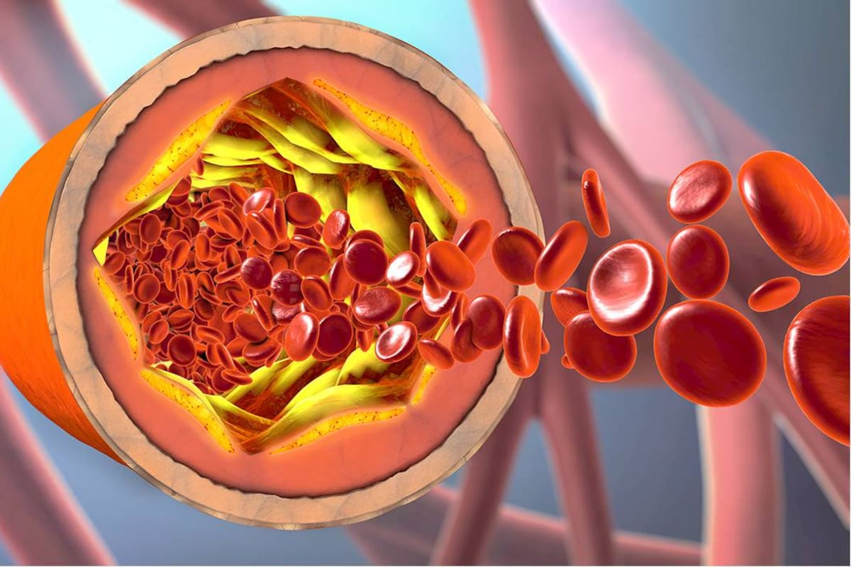 Existen tres fracciones conocidas de colesterol: el bueno, el malo y el feo