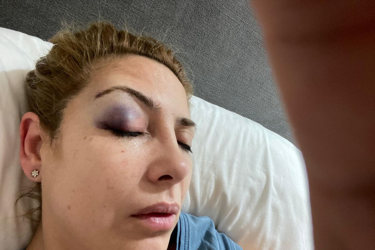 Fabiola Yañez, con un moretón