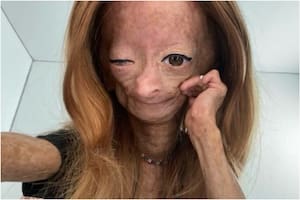Falleció la influencer que tenía "el síndrome de Benjamin Button"