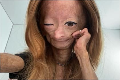 Falleció la influencer que tenía "el síndrome de Benjamin Button"