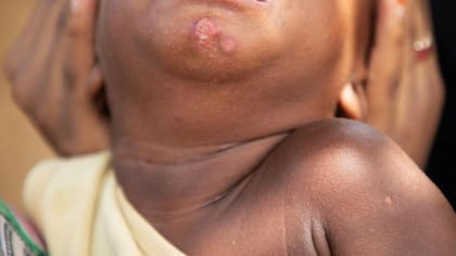 Fátima le aplicó la cremas a todos sus hijos desde que eran bebés y muchos ahora presentan cicatrices y otros problemas de salud.