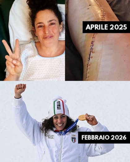 Federica Brignone en dos versiones: cómo quedó tras la operación y ahora, tras ser campeona en Super-G