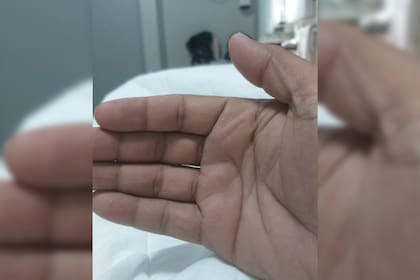 Finalmente, las manos del paciente volvieron a su color natural (Captura Twitter @AleGinzo_MD)