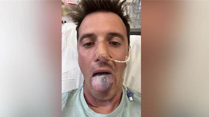 Finalmente se descubrió un tumor en la base de la lengua de Anthony.