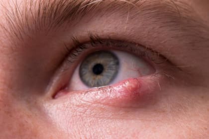 Frotarse los ojos puede irritar los párpados y contribuir a la obstrucción de las glándulas sebáceas, lo que puede dar lugar a la formación de un orzuelo