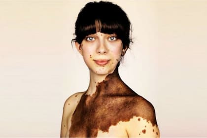 Gemma Whyatt nació con enormes manchas que le cubren la parte superior de la espalda, el cuello, el pecho y la oreja, además de cientos de marcas más pequeñas en el resto del cuerpo. El nevus melanocítico congénito afecta al 1% de la población.