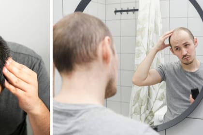 Genética, estrés, cambios hormonales, mala nutrición y enfermedades como el hipotiroidismo están entre las causas más comunes de la pérdida capilar