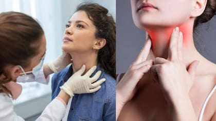 Glándula Tiroides es una de las partes del cuerpo más afectada por el consumo elevado de yodo
Foto: iStock