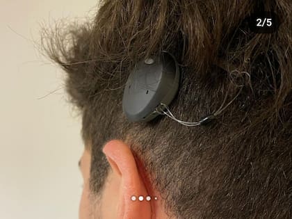 “Gracias al implante tengo la habilidad de escuchar si me hablan de los dos lados y encima a un volumen más cercano a lo normal".