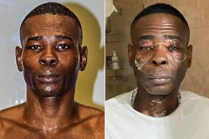 Guillermo Rigondeaux en una imagen combinada. Antes y despues de las quemaduras.
