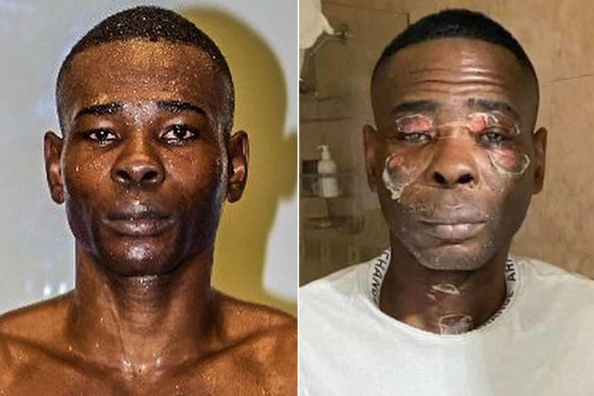 Guillermo Rigondeaux sufrió hace unos meses un gravísimo accidente doméstico en el cual se quemó el rostro; de a poco, va recuperándose