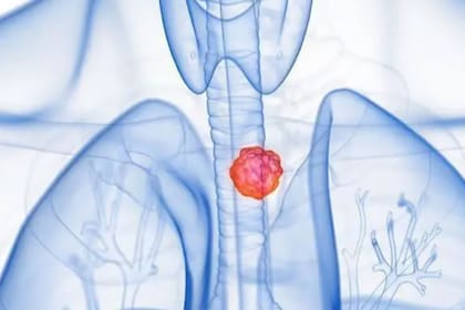 Hacer quimioterapia antes y después de la cirugía aumenta la supervivencia de los pacientes con tumores de esófago