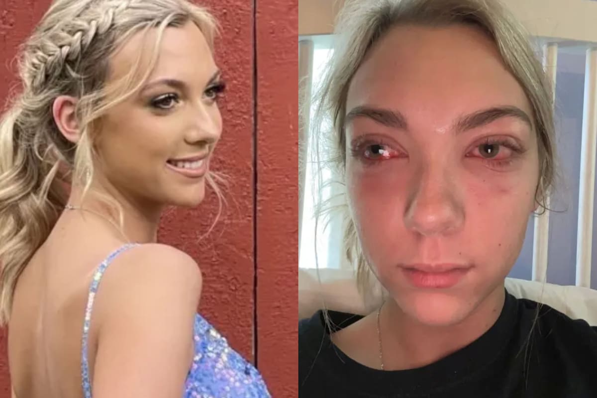 Haley Fetzer sufrió grave alergia en sus ojos. FOTO: TikTok: @haley.fetzer_