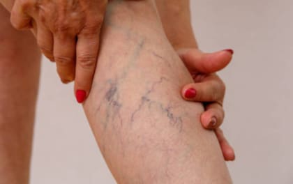Hay actividades que favorecen la proliferación de varices (Foto: El Tiempo)