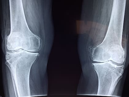 Hay varias formas de cuidar los huesos como consumir vitamina D o realizar ejercicio de manera regular