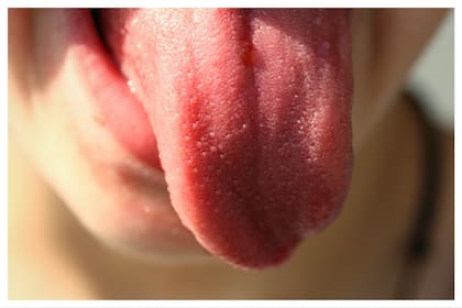 Hay varios motivos por el cual una lengua puede blanquearse