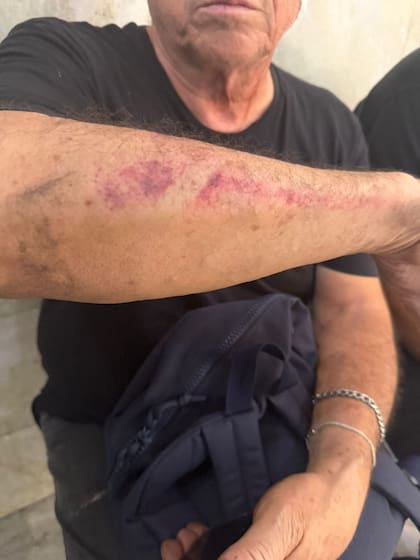 Hematomas en uno de los brazos del padre del agresor, producto de la golpiza previa al atropello