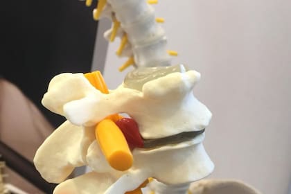 Hernia de disco, la parte roja muestra la compresión del nervio ciático