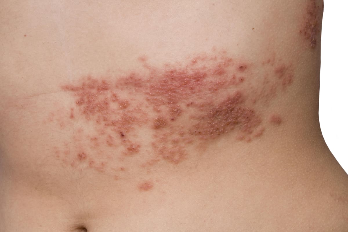 Herpes Zóster.