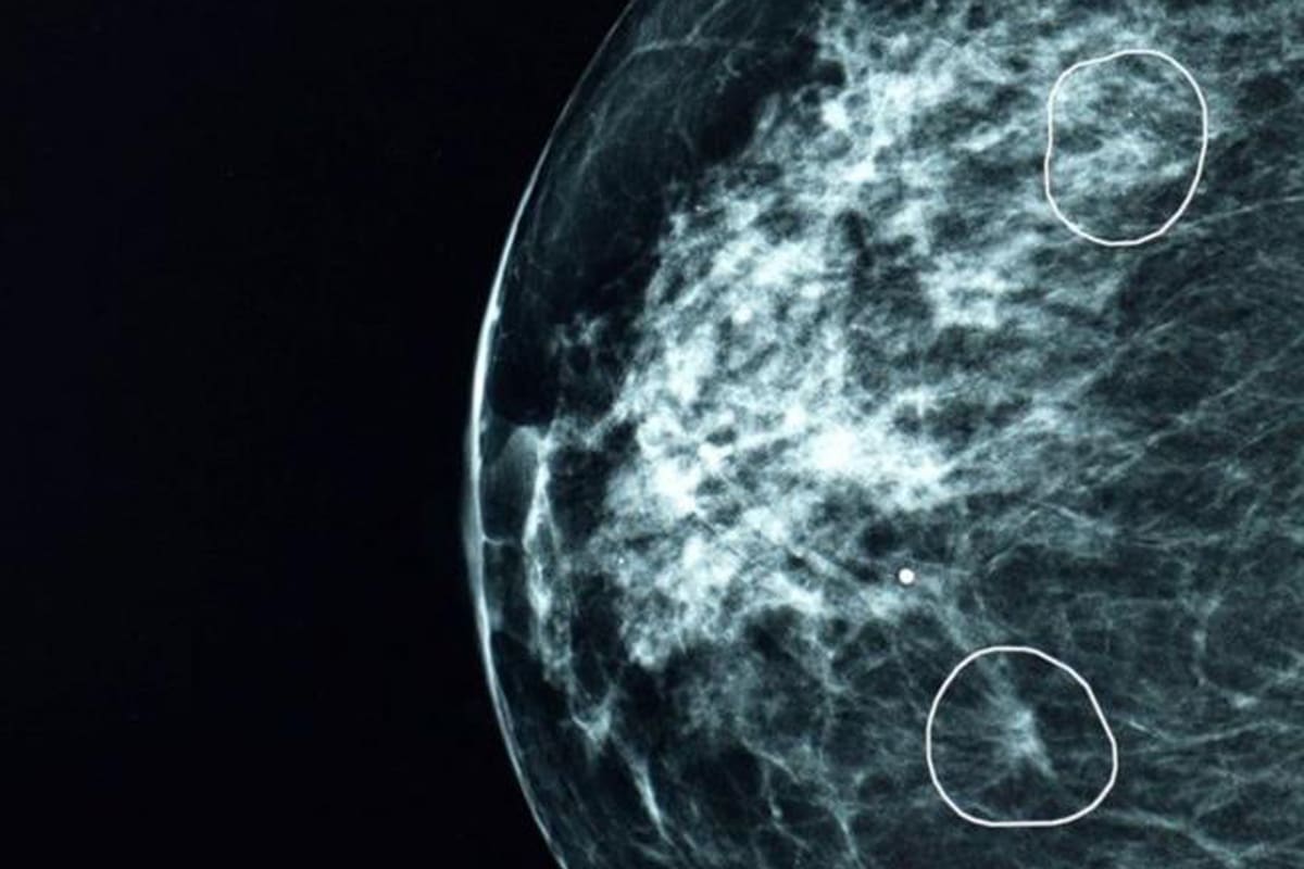 Herramienta MIA; BBC; BBC mundo; Cáncer ; Cáncer de mama; Sarah Kerruish; Kheiron Medical; Tumores; tumor; Inteligencia artificial; Sociedad; Salud;